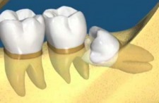 انواع نهفتگی در دندانها