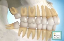 نهفتگی دندان