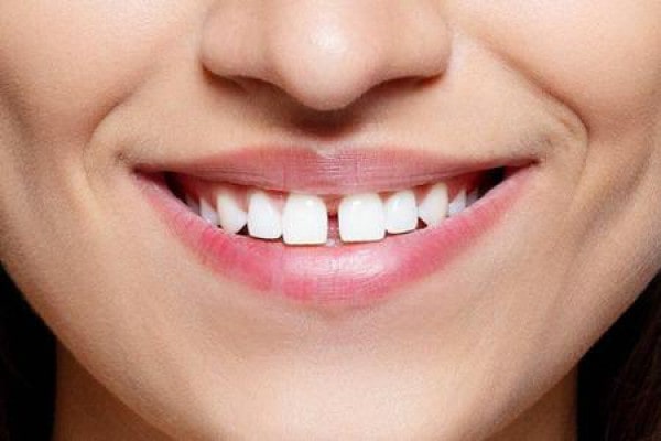 فاصله بین دندان‌ها چگونه اصلاح می شود؟