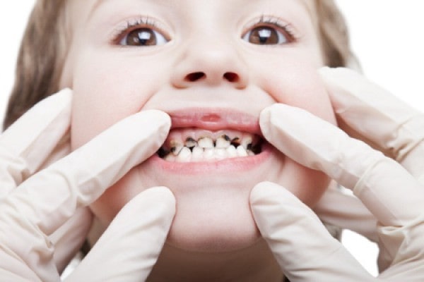 آیا قطره آهن عامل خراب شدن دندان نوزاد است؟
