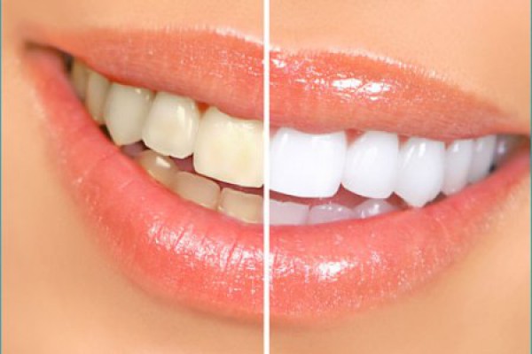 سفید کردن دندان‌ قبل یا بعد از ارتودنسی