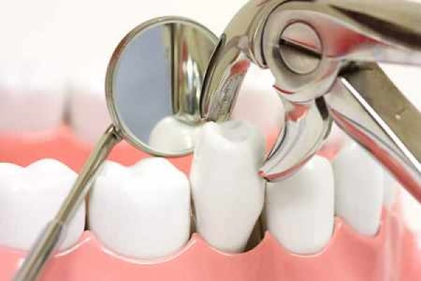 کشیدن دندان در درمان ارتودنسی اجتناب ناپذیر است؟