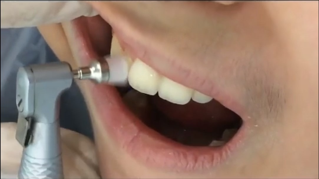 تمیز کردن سطح دندان ها قبل از قرار دادن دستگاه ارتودنسی ثابت
