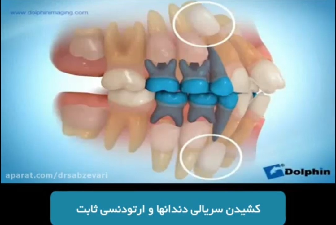 کشیدن سریالی دندان ها و ارتودنسی ثابت