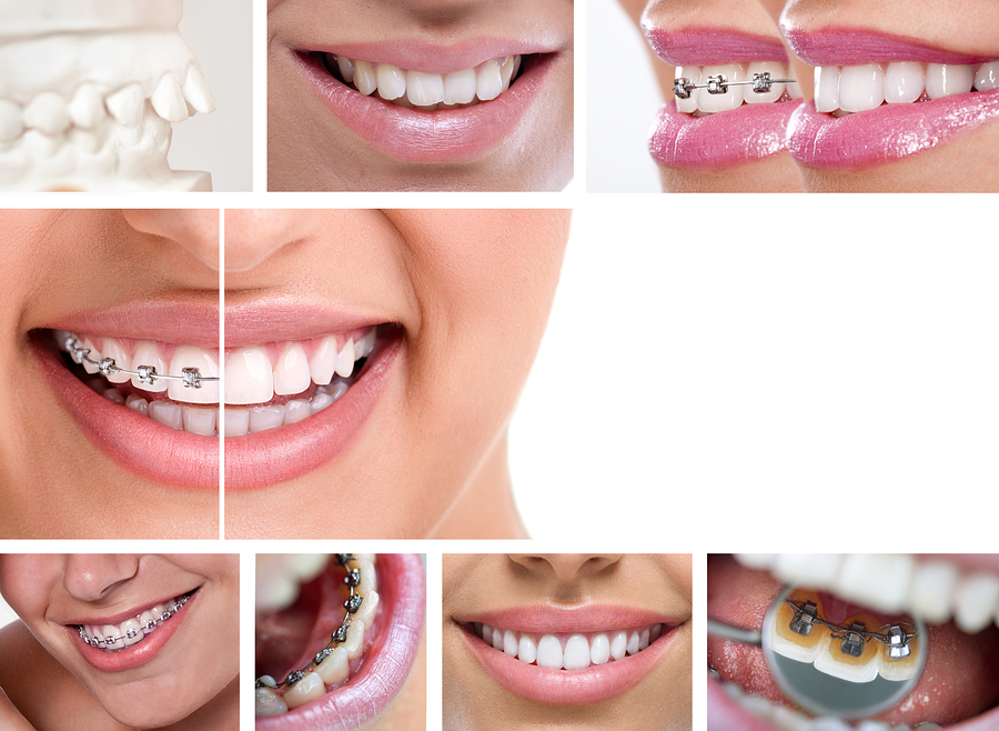 درمان نامرتبی و بی نظمی دندان ها