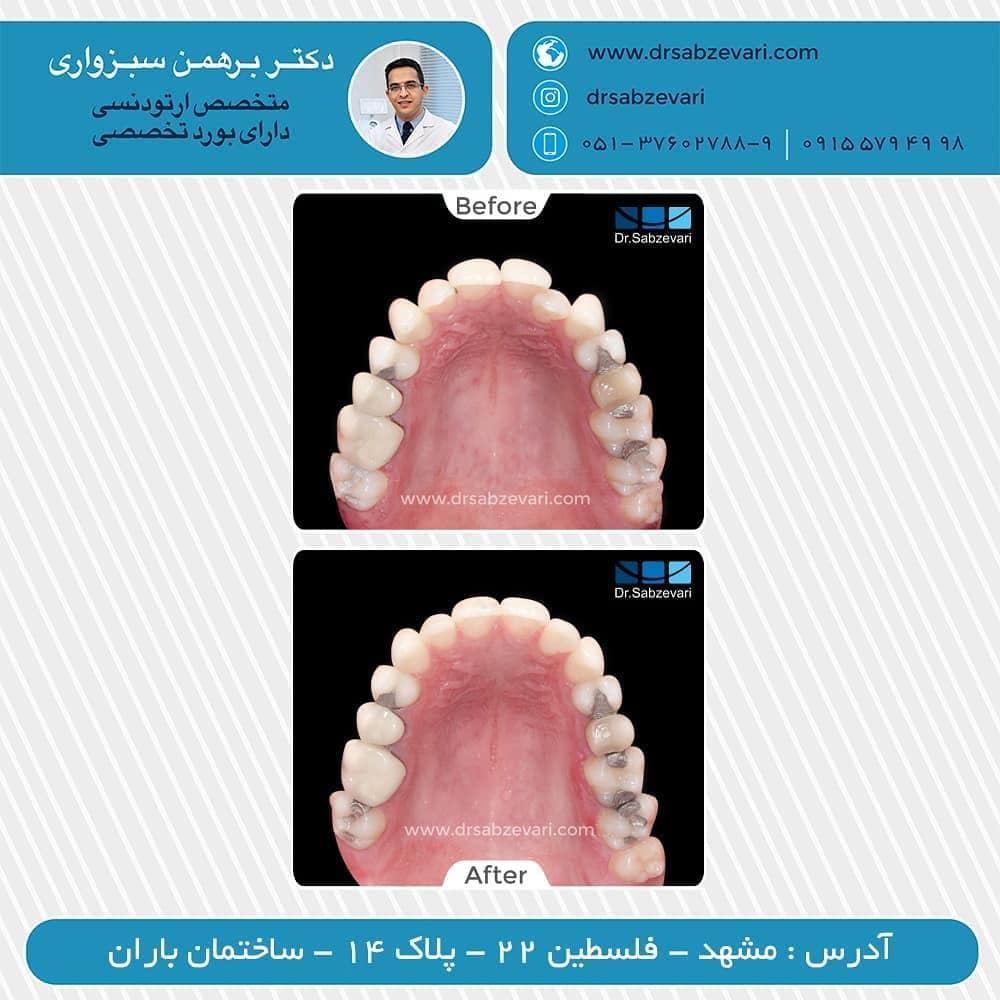 Fixed-maxillary-orthodontics-1
