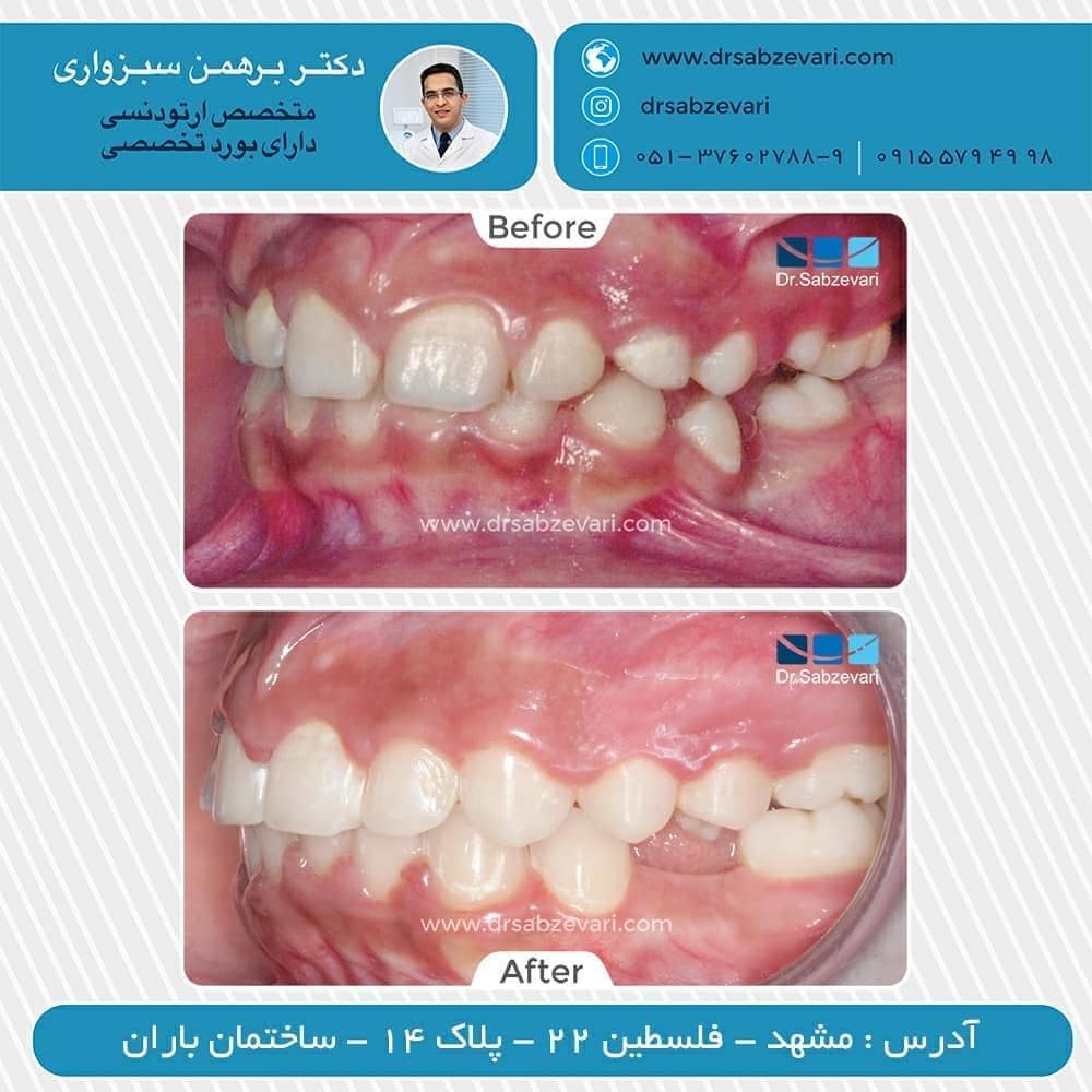 Fixed-maxillary-orthodontics-2