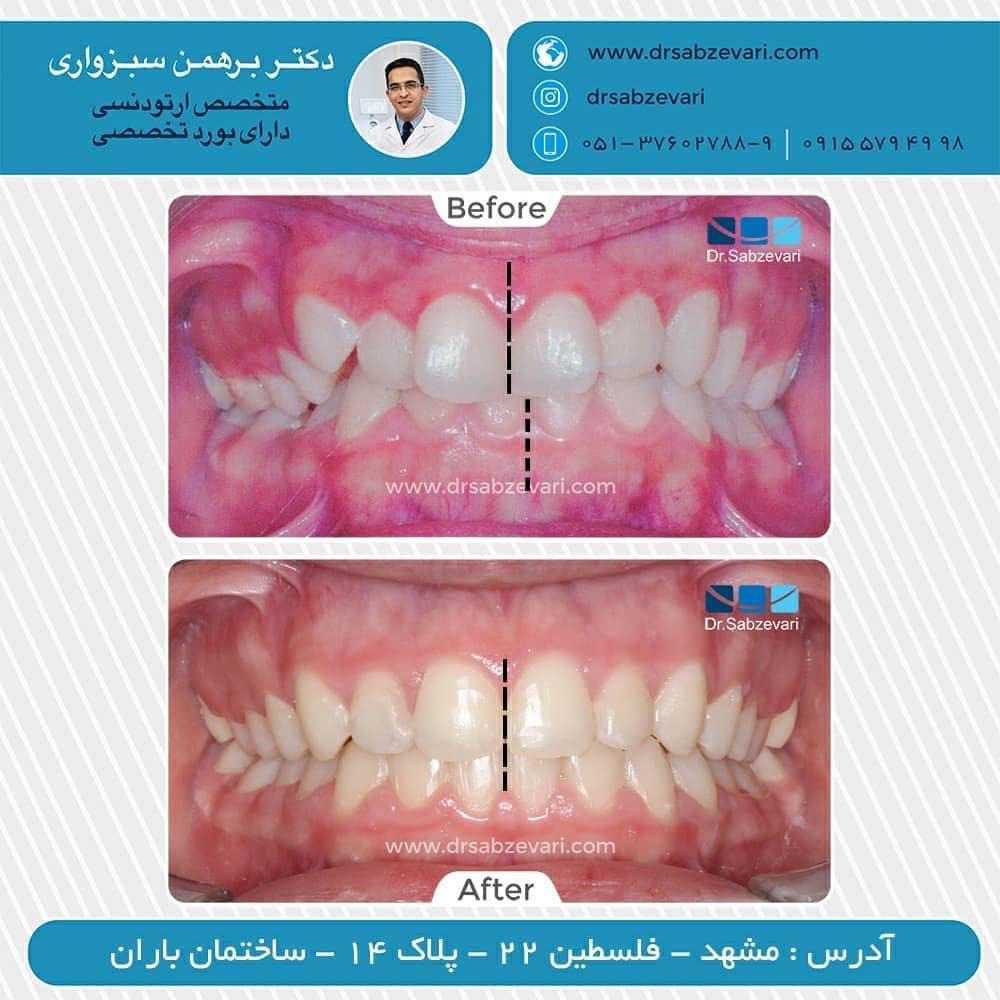 Fixed-orthodontic-treatment-1