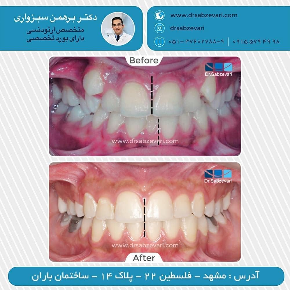 Fixed-orthodontic-treatment-by-extracting-three-teeth