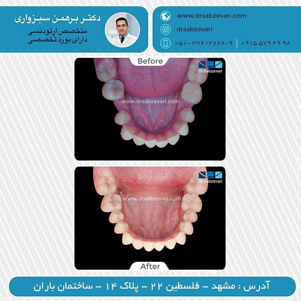 Fixed-orthodontic-treatment-of-two-jaws-1
