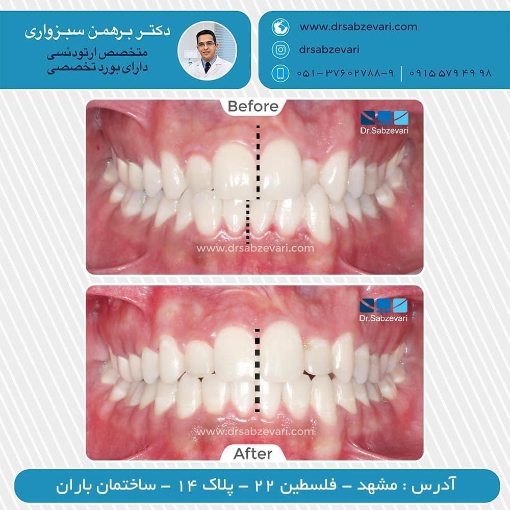 Fixed-orthodontic-treatment