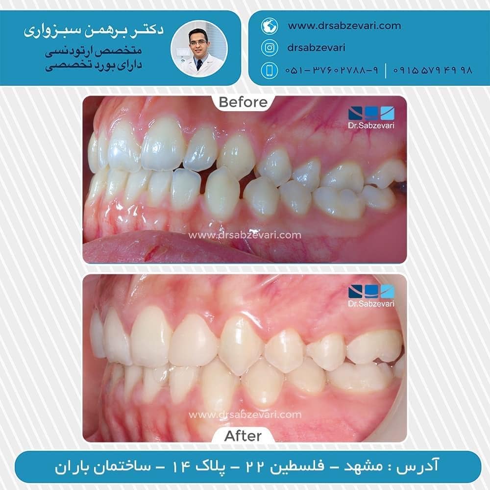Fixed-orthodontics-1