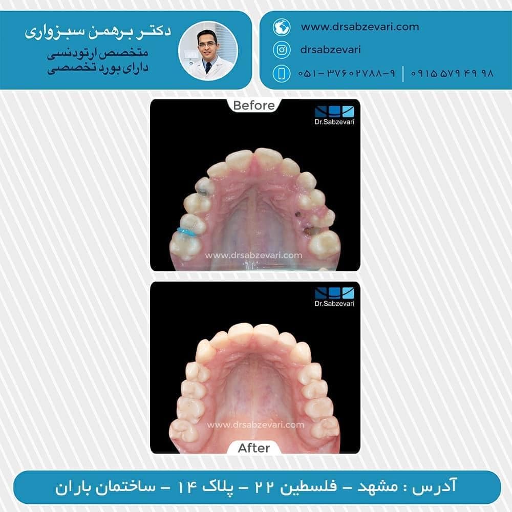 Fixed-orthodontics-2