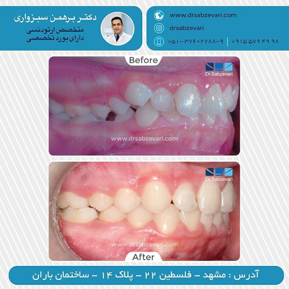 Fixed-orthodontics-4