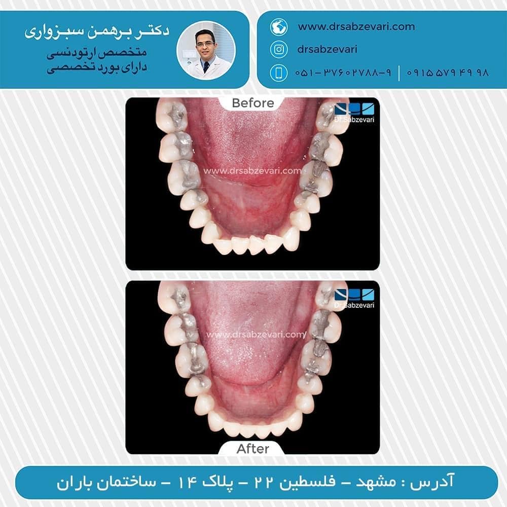 Fixed-orthodontics-of-the-upper-and-lower-jaw