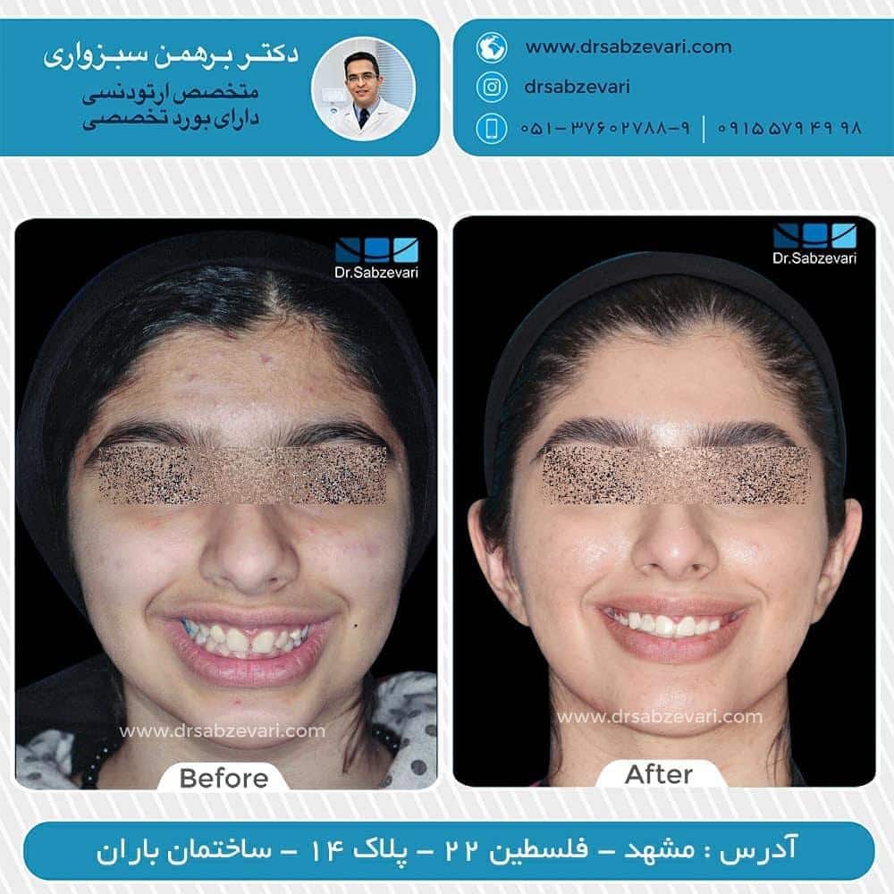 Fixed-orthodontics-of-two-jaws-1