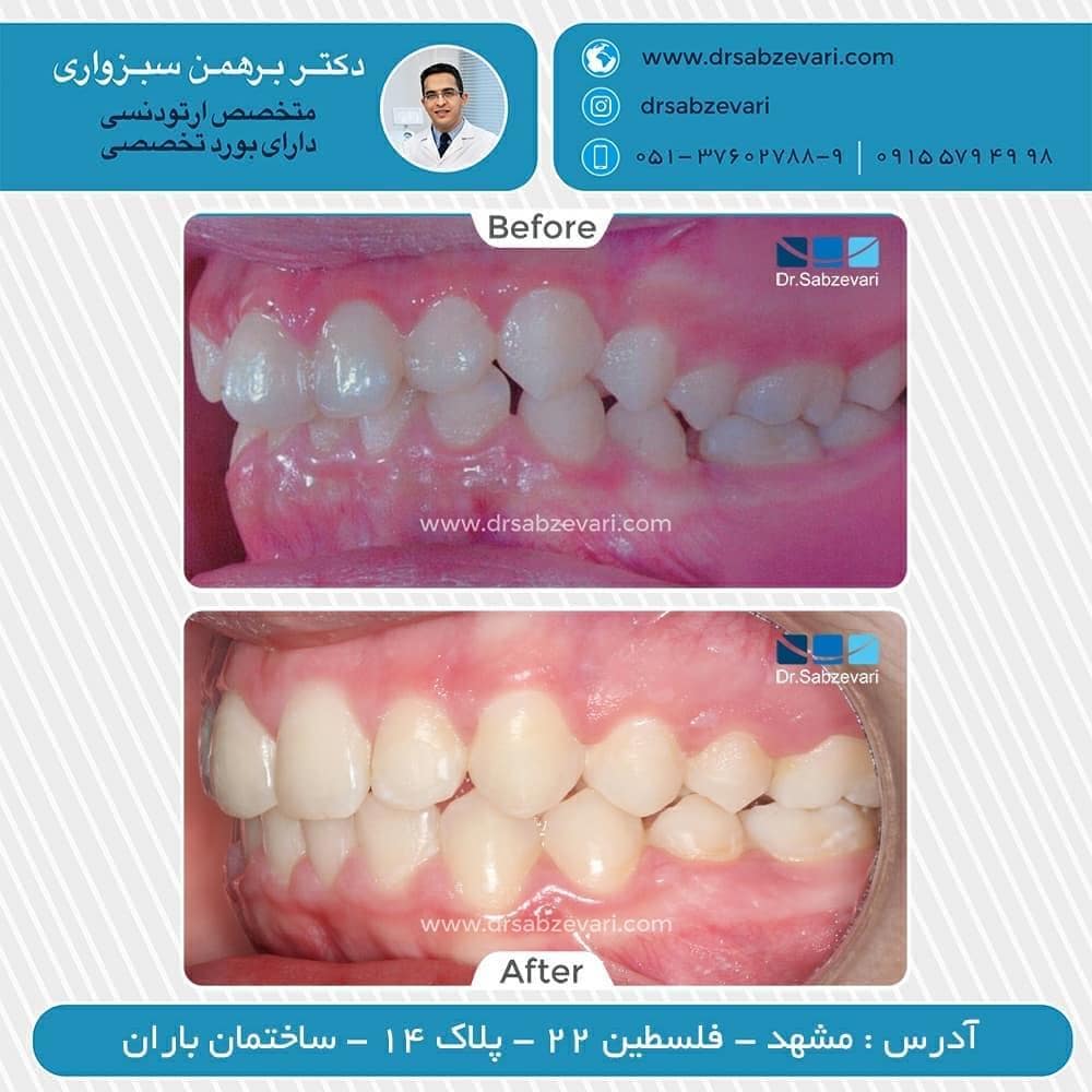 Fixed-orthodontics-of-two-jaws-2