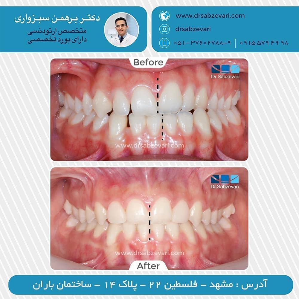Fixed-orthodontics-of-two-jaws