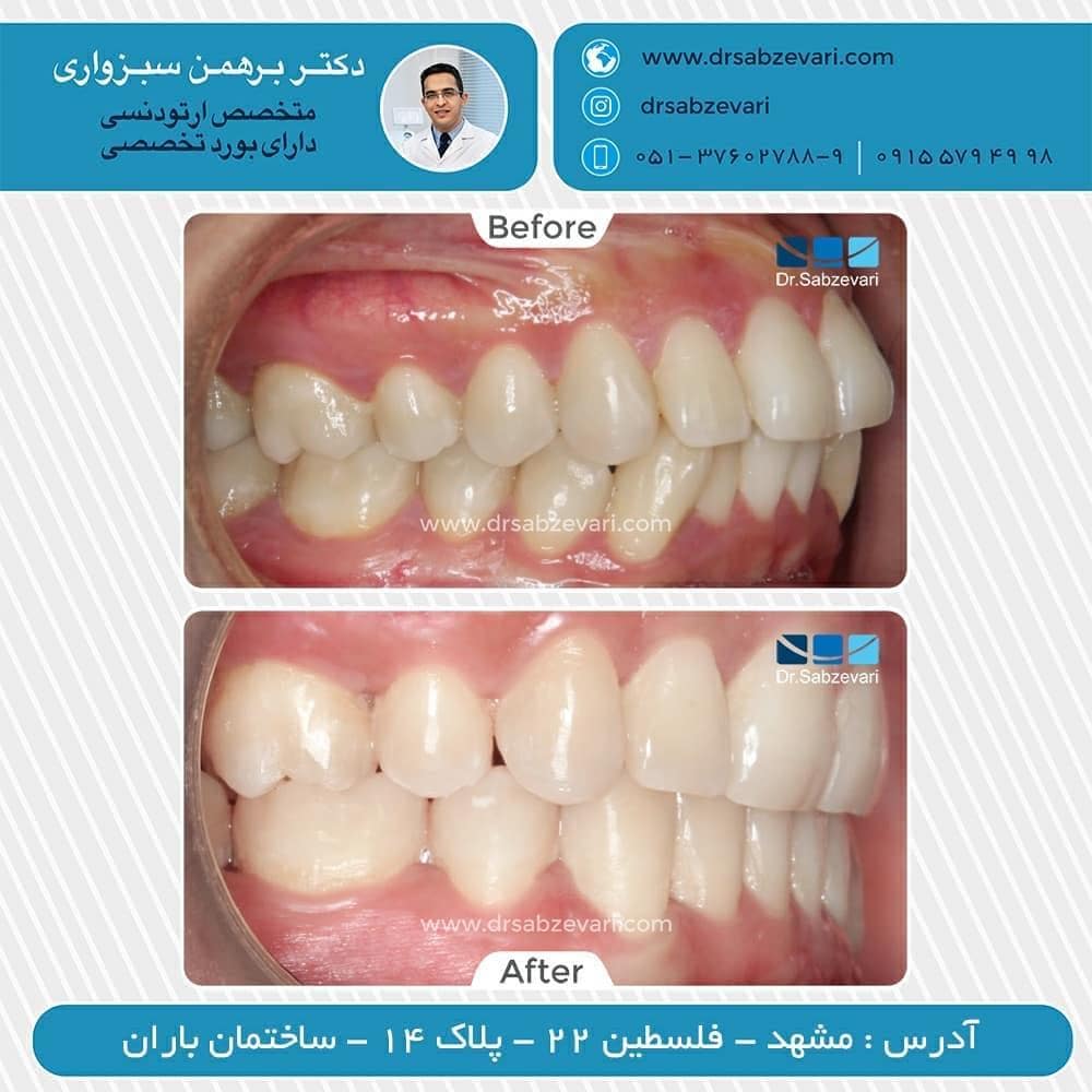 Fixed-orthodontics-with-tooth-extraction