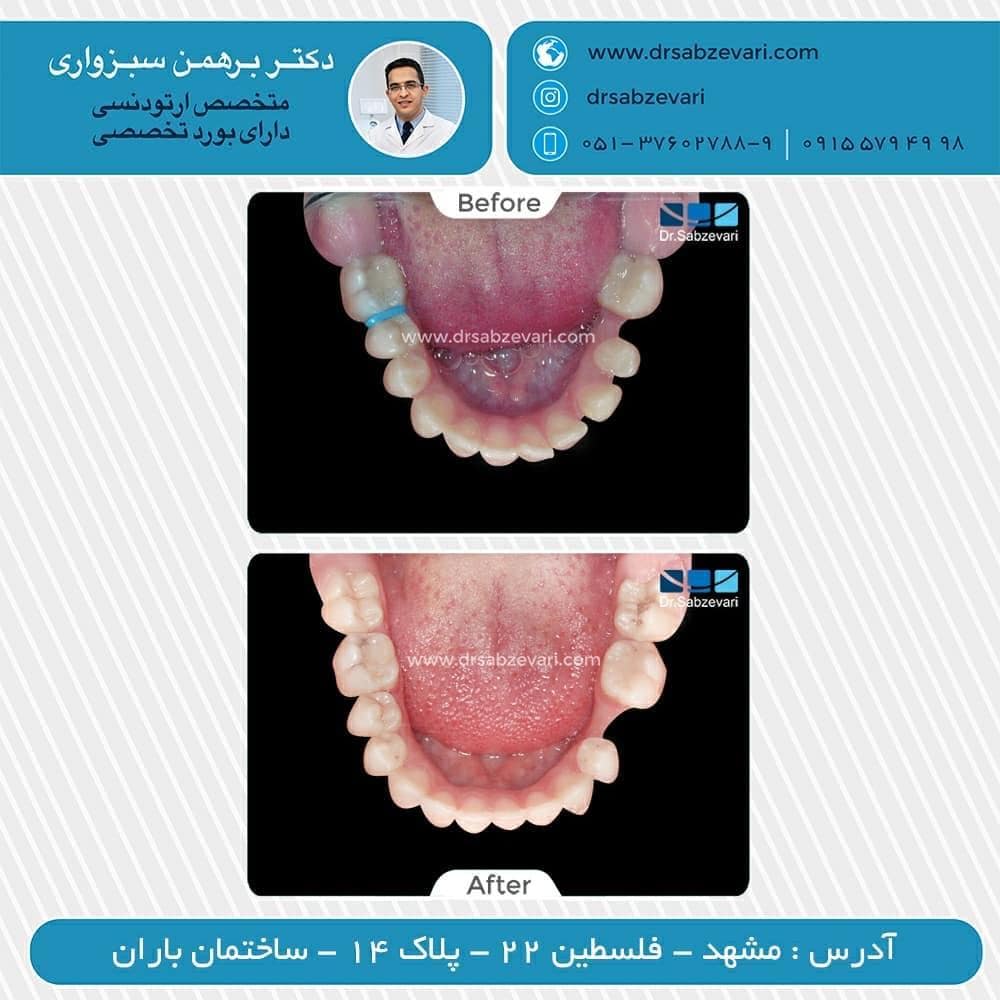 Fixed-orthodontics-without-tooth-extraction