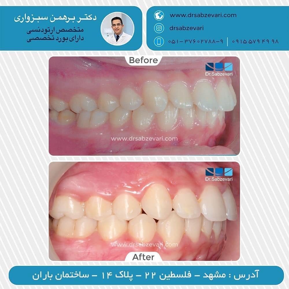 Jaw-orthodontic-treatment