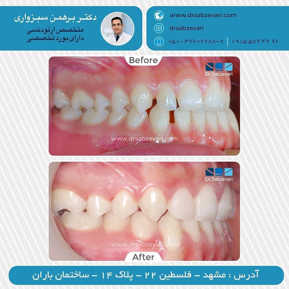 Jaw-orthodontics
