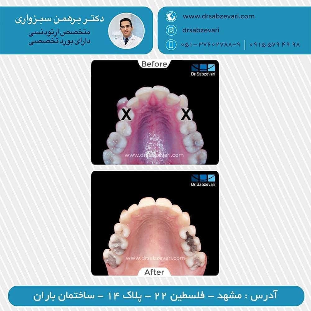 Maintenance-period-of-orthodontic-treatment