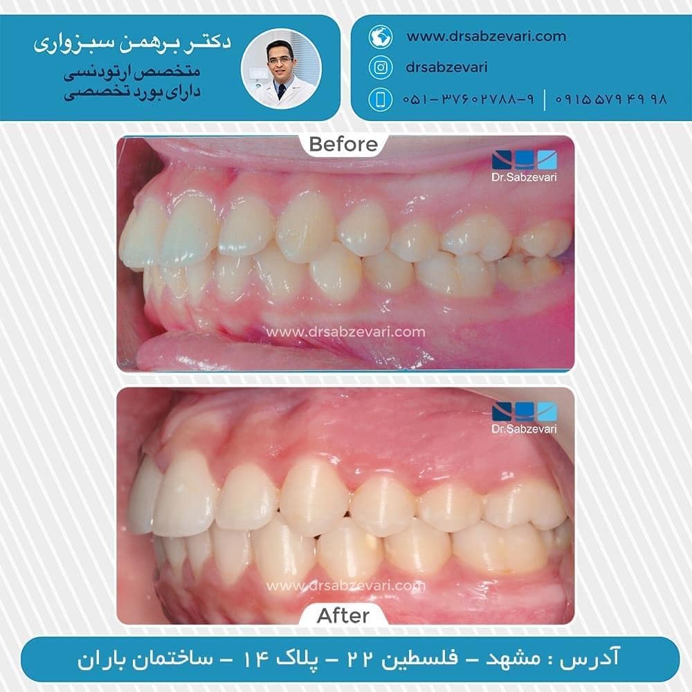 Maxillofacial-orthodontic-treatment
