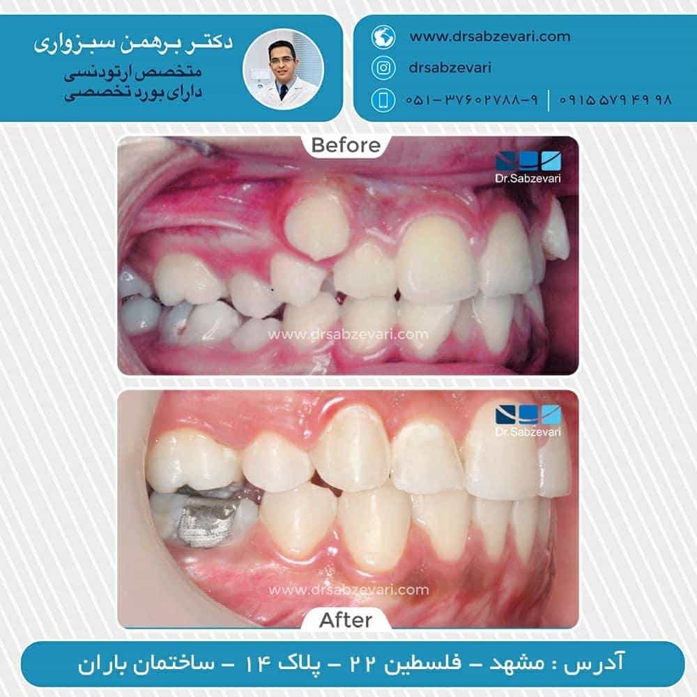 Orthodontic-maintenance