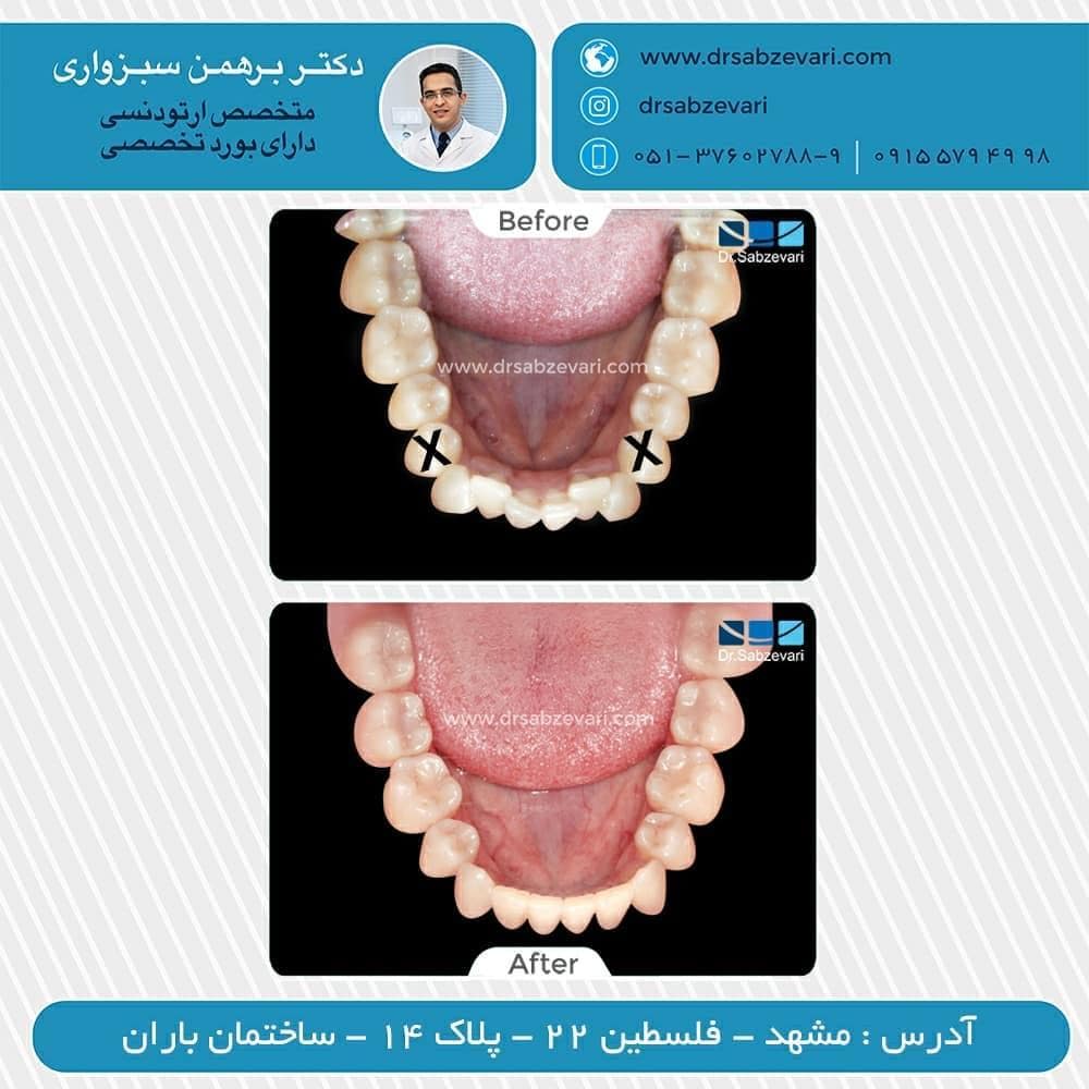 Orthodontic-retainer
