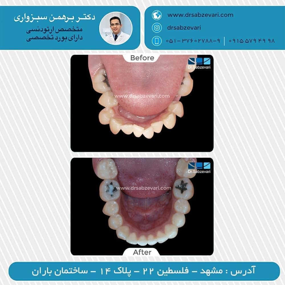 Orthodontic-treatment-with-removable-retainer