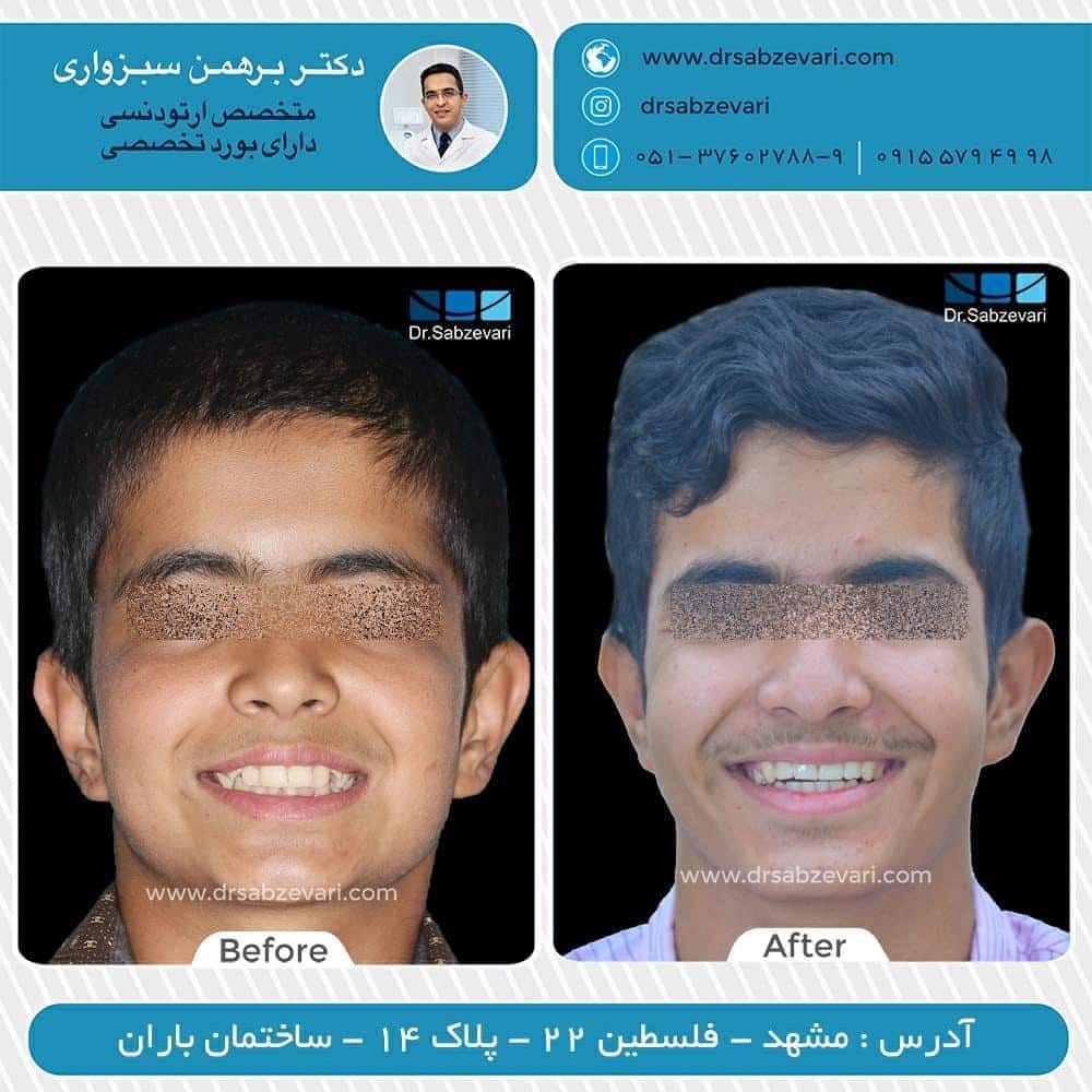 Orthodontic-treatment-without-permanent-tooth-extraction