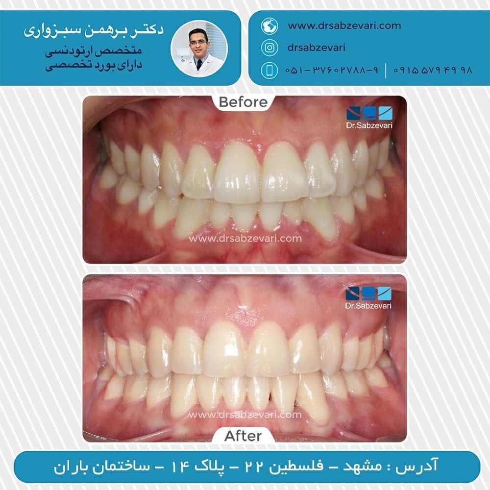 Orthodontic-treatments