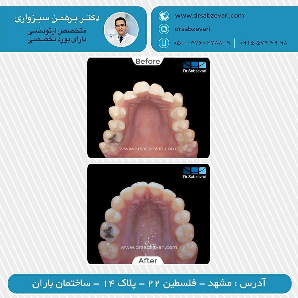 Orthodontics-with-removable-retainer