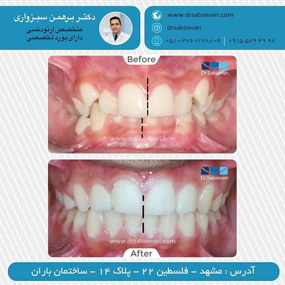 Orthodontics-without-permanent-tooth-extraction