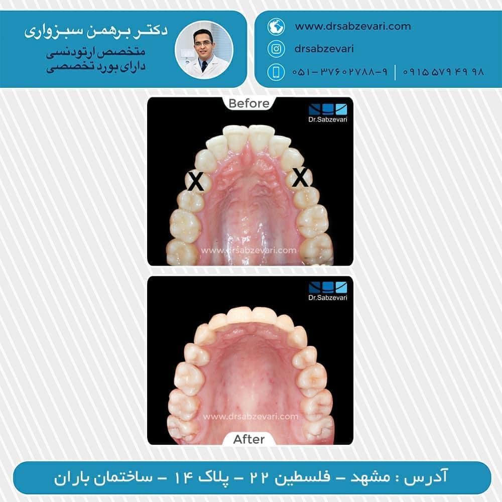 Removable-orthodontic-retainer