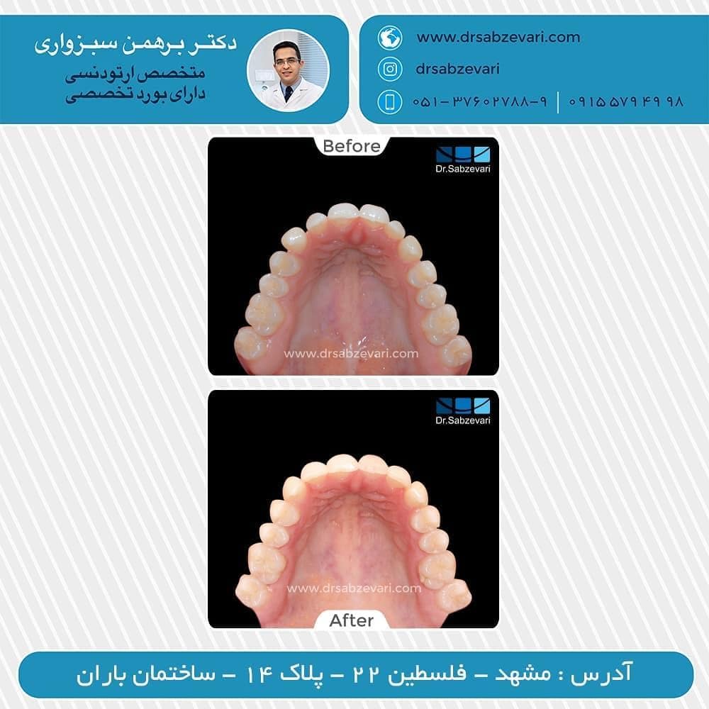 Two-jaw-orthodontic-treatment