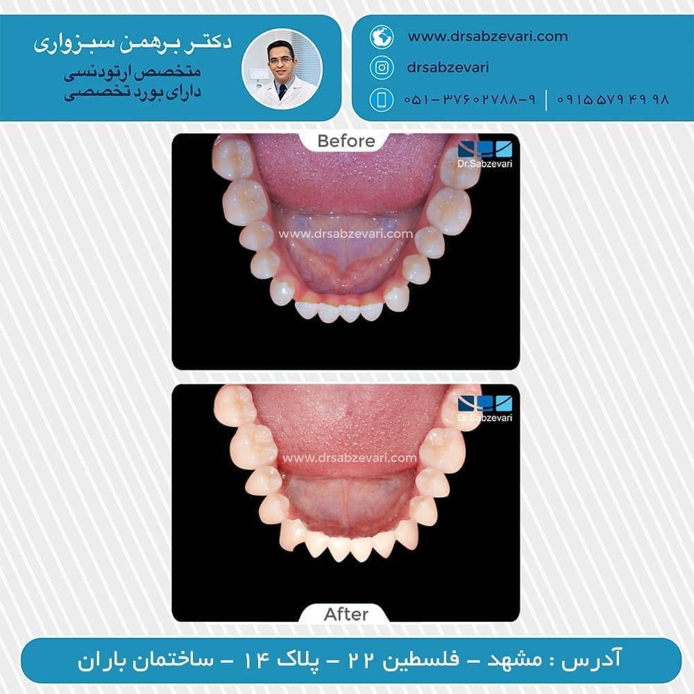 Two-jaw-orthodontics